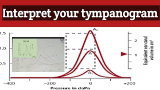 Tympanometry test  Tympanogram interpretation  how to read tympanogram selflessmedicose [upl. by Netniuq]