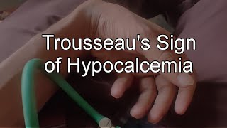 Trousseaus Signcarpopedal spasm in Hypocalcemia [upl. by Langston]