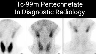 Stomach Colon and thyroid Cancer Detection by 99mTC Pertechnetate [upl. by Nimad]