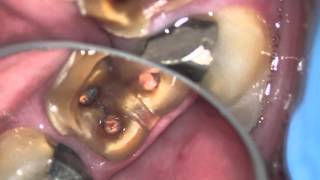 LOOSE TEETH POOR FERRULE EFFECT [upl. by Hillard]