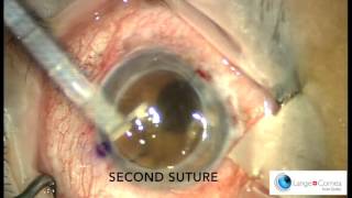 Perforating Keratoplasty PKP by Dr Alex Lange [upl. by Rhynd679]