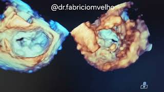 Necrose caseosa no anel mitral Componente móvel em face Ventricular [upl. by Gerda690]