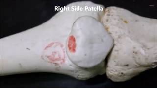 PATELLA FEMOROPATELLAR JOINT Q ANGLE GENU Valgum Varum Dislocation – Sanjoy Sanyal [upl. by Jeannie]