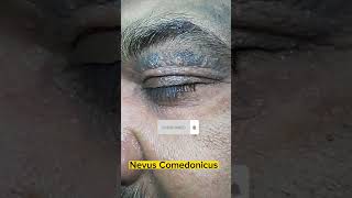 Comedo Nevus😱🔥  Nevus Comedonicus on upper eyelid in old patient dermatology comedone acne scar [upl. by Martine322]