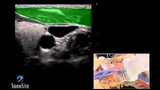 How To Ultrasound Guided Insertion Internal Jugular Catheter Trans  Sonosite Ultrasound 3D Video [upl. by Aitital803]