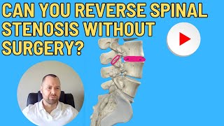 Can you reverse spinal stenosis without surgery [upl. by Nnil]