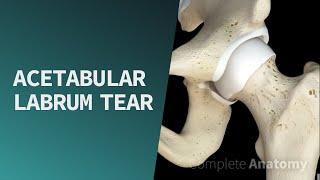 Acetabular Labrum Tear  Pathologies [upl. by Filiano470]