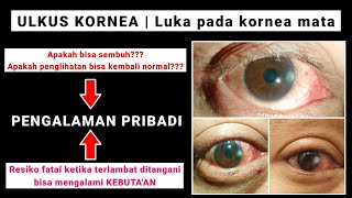 BERCAK PUTIH DIMATA  PENYAKIT MATA  ULKUS KORNEACORNEAL ULCER  Luka terbuka pada kornea mata [upl. by Oj443]