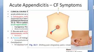 Surgery 836 Acute Appendicitis symptom sign clinical feature dunphy cough Blumberg rebound Rovsing [upl. by Nohs]