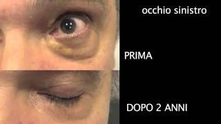 Xantelasma Prima e Dopo Rimozione con RF dr C Orione [upl. by Jeanie]