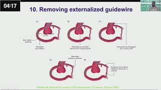 Retrograde CTO PCI Tips amp Tricks Wire Externalization by Dr Aftab khan [upl. by Flossie]