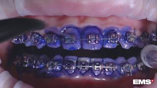 Cleaning Orthodontic Appliances with GBT Guided Biofilm Therapy [upl. by Berardo]