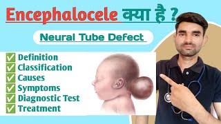 Encephalocele in Hindi  Causes Symptoms And Treatment of Encephalocele [upl. by Euqinoj]