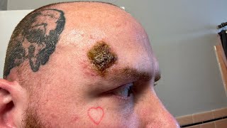 End Of Week 3 Superficial Basal Cell Carcinoma Skin Cancer Aldara Treatment [upl. by Sillert198]