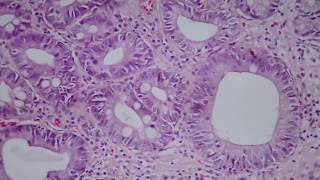 013 Intestinal metaplasia and low grade dysplasia in gastric biopsy [upl. by Noell148]