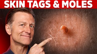 Use Iodine for Skin Tags and Warts – DrBerg on Skin Tag Removal [upl. by Androw782]