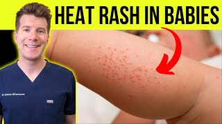 Doctor explains HEAT RASH miliaria in a baby  Causes symptoms treatment and prevention [upl. by Honeywell637]