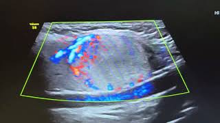 Ultrasound of hyperplastic adenomatous nodule in right lobe of thyroid [upl. by Sisak979]