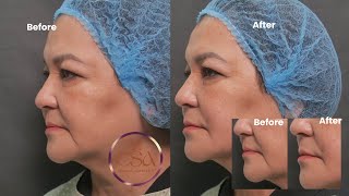 “Maintaining a natural youthful look for those ages 60 and above “  Dr Contessa Salvador  Alapag [upl. by Eimar]