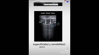 17 ¿cómo diagnosticar un Neumotórax por ecografía [upl. by Eikcim]