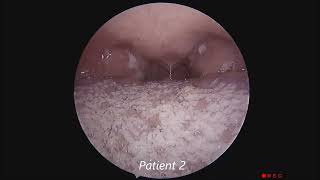 Acute Membranous Tonsillitis [upl. by Byrom]