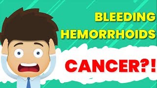 Can Hemorrhoids Be A Sign of Cancer  Best Hemorrhoids amp Piles Answers [upl. by Akerdal]