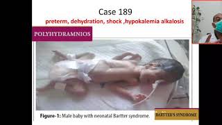 Case 189 hypokalemic metabolic alkalosis Bartter syndrome hyperprostaglandin Syndrome hypercalciu [upl. by Xylia]