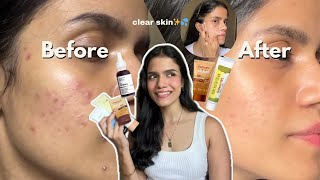 How I got rid of acne marks in 1 month Products that worked for me ✨ sunscreenmoisturiserserum [upl. by Moraj251]