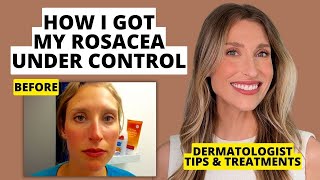 My Rosacea Journey Dermatologist Shares Skincare amp Treatments That Work  Dr Sam Ellis [upl. by Naillimxam]