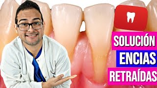 ENCÍAS RETRAÍDAS 👄 Solución VERDADERA😮 a la RETRACCIÓN GINGIVAL ✔️ 2018 [upl. by Nahbois999]