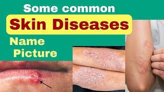 Skin diseases name and picture  skin diseases picture with name  skin problem [upl. by Stepha]