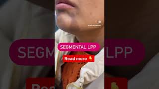 Segmental lichen Planus Pigmentosus Treatment drashimagoel skincare parisaskinclinic [upl. by Falzetta]