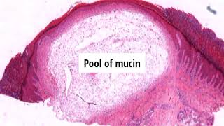 Pathology of Digital Mucous Myxoid Cyst by Dr Sampurna Roy MD  dermatopathology dermpath [upl. by Danczyk852]