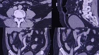 Superior Mesenteric Artery  SMA  arteritis or vasculitis  rare case  CT findings [upl. by Wappes920]