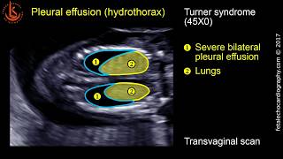 Fetal echocardiography at 1113 weeks Pleural Effusion Hydrothorax [upl. by Erickson]