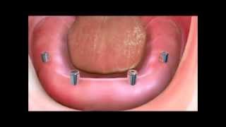 Implant Supported Dentures [upl. by Rosel]