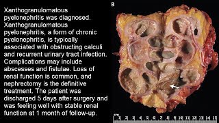 Xanthogranulomatöse Pyelonephritis [upl. by Yrocaj988]