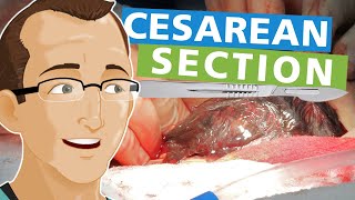 Cesarean Section [upl. by Lainahtan]