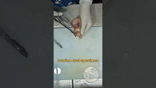 Ovarian cyst specimen grossing 🧐 [upl. by Pantheas]