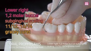 Lower right 12 molar buccal subgingival scaling 1112 1314 gracey curet [upl. by Leamse]