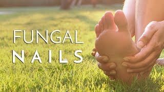 Principal Podiatrist Michael Lai Explains What Causes Fungal Toenails [upl. by Turnbull]