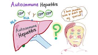 Autoimmune Hepatitis Lupoid hepatitis [upl. by Nellahs225]