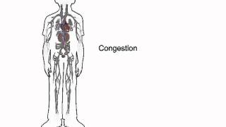 How heart failure causes fluid accumulation  wwwheartfailuremattersorg [upl. by Alorac]