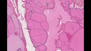 Histopathology ThyroidColloid goiter [upl. by Etnaed335]