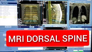 Dorsal Spine MRI scan Protocol Positioning amp Planning [upl. by Lynea]