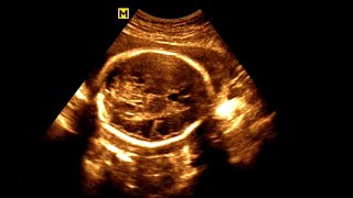 Routine antenatal ultrasound at 28 weeks gestation Ultrasonography of a 28week pregnancy [upl. by Erb828]