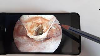 Anatomy of Laryngopharynx HypopharynxENT [upl. by Elmer]