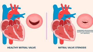 Mitral Stenosis [upl. by Edroi]