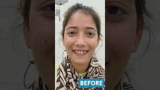 Laser Gum Reshaping Gingivoplasty by Dr Srishti Bhatia [upl. by Assyral414]