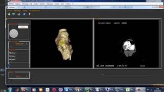 Reconstruction 3D pour images DICOM using VTK [upl. by Amathist]